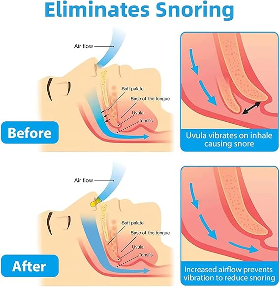 Anti Snoring Nose Clips for Men & Women - Magnetic Snore Stopper for Better Sleep – Soft Silicone Nasal Device - Reusable Snoring Solution (6 Pack)